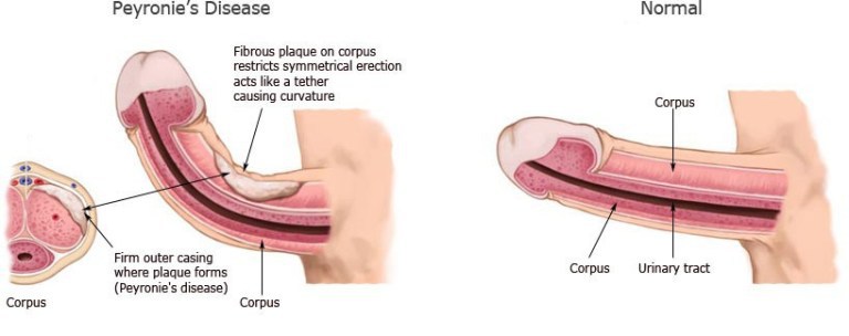 peyronie's disease treatment in Calgary to straighten the shaft